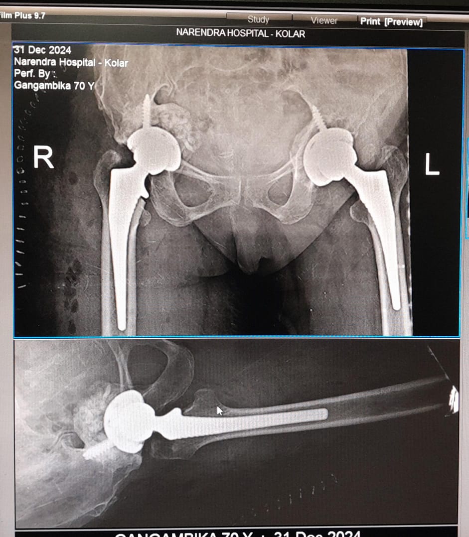 After hip fracture fixation X-ray with plate and screws